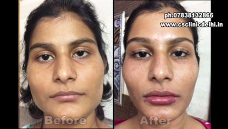 Face Slimming Treatment In Gurgaon