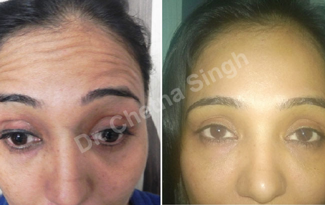 Botox Treatment in Gurgaon