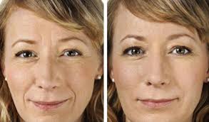 Wrinkles between eyebrows treated