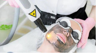 Carbon Laser Facial in Gurgaon