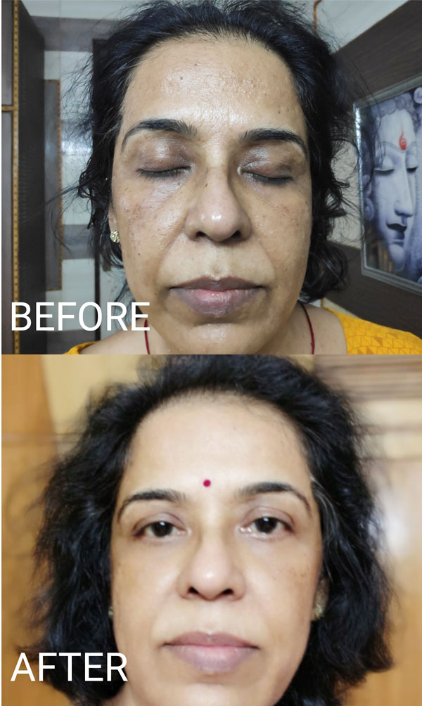 Carbon Laser Facial in Gurgaon