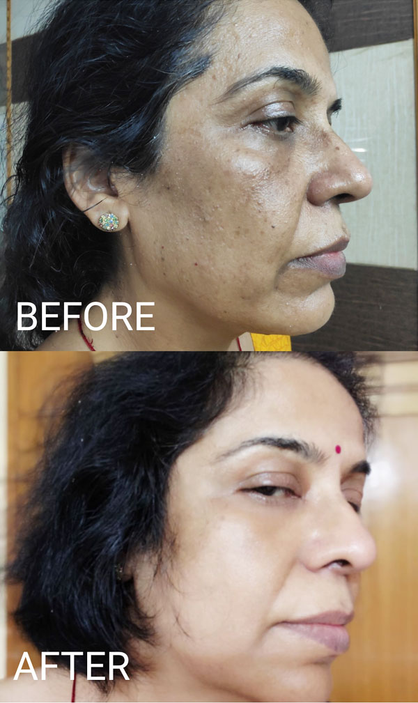 Carbon Laser Facial in Gurgaon