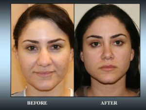 Non Surgical Nose Reshaping in Gurgaon