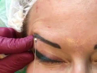 Eyebrow Lift Surgery in Gurgaon