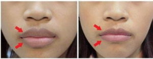 Lip Reduction Surgery In Gurgaon