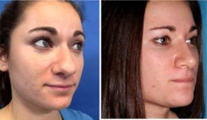 Non Surgical Nose Reshaping in Gurgaon